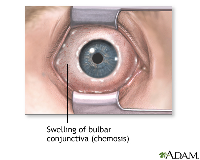 Chemosis Chemosis