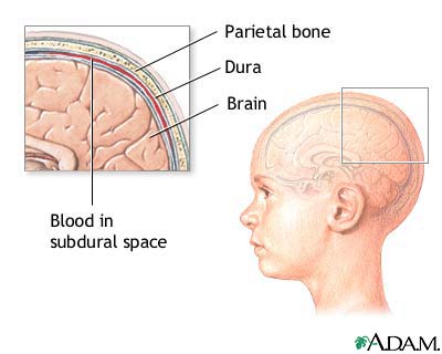 Increased intracranial pressure Increased intracranial pressure