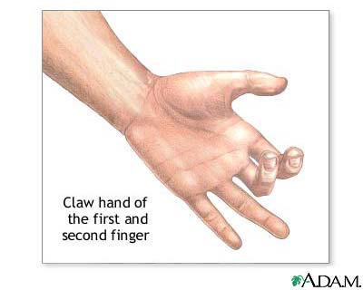 Claw hand Claw hand