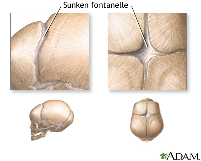 Sunken fontanelles (superior view) Sunken fontanelles (superior view)