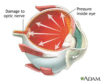 Glaucoma Glaucoma