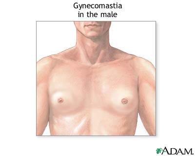 Gynecomastia Gynecomastia