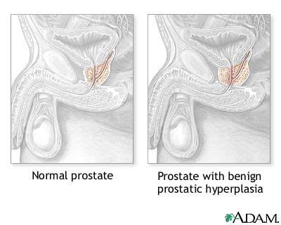 Hyperplasia Hyperplasia