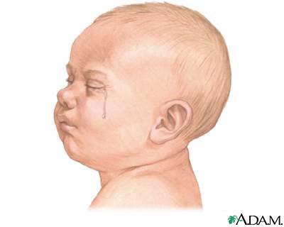 Crying - excessive (0 to 6 months)