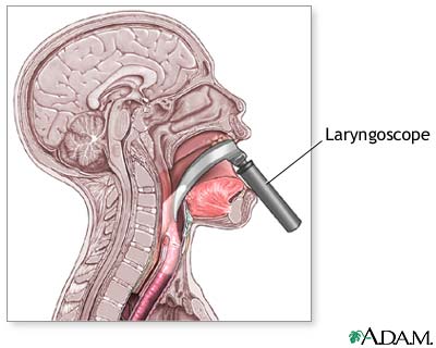 Laryngoscope Laryngoscope