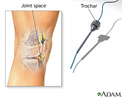 Synovial biopsy Synovial biopsy