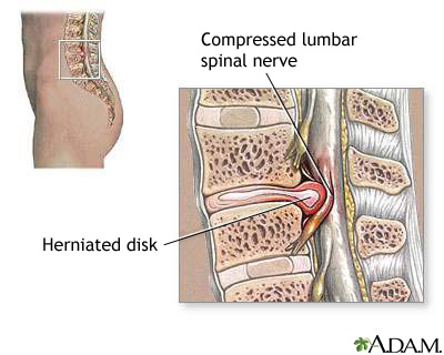 Herniated lumbar disk Herniated lumbar disk
