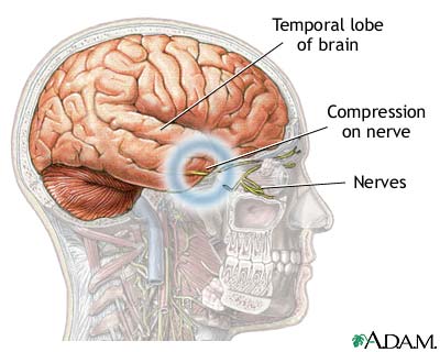 Brain herniation Brain herniation