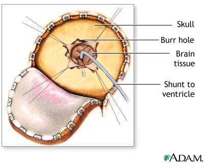 Craniotomy for cerebral shunt