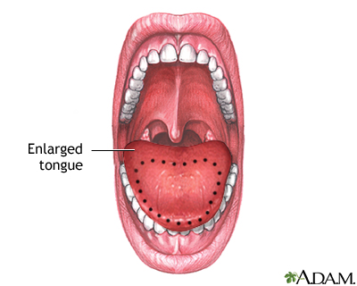 Macroglossia Macroglossia