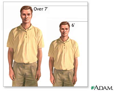 Macrosomia Macrosomia