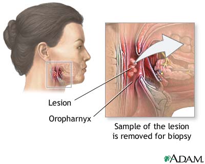 Oropharyngeal biopsy Oropharyngeal biopsy