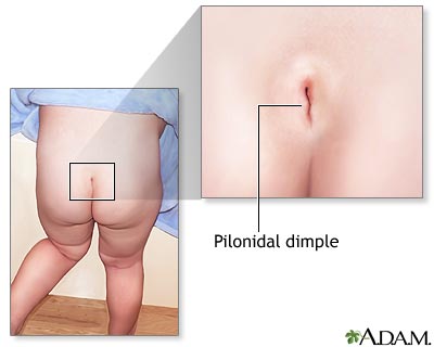 Pilonidal dimple