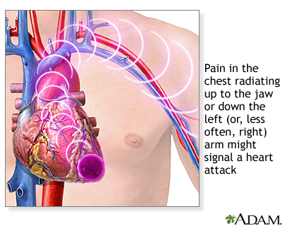 Heart attack symptoms Heart attack symptoms