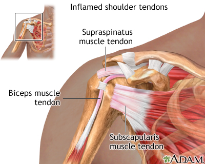 Inflamed shoulder tendons Inflamed shoulder tendons