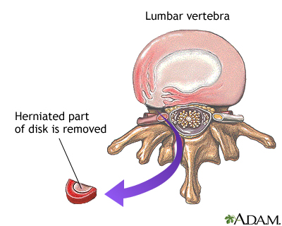Herniated disk repair Herniated disk repair