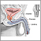 Transurethral Resection of the Prostate (TURP) - Series Transurethral Resection of the Prostate (TURP) - Series