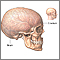 Craniotomy - series Craniotomy - series