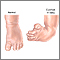 Clubfoot repair - series Clubfoot repair - series