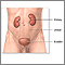 Kidney removal (nephrectomy) - series Kidney removal (nephrectomy) - series