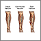 Bone fracture repair - series Bone fracture repair - series