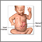 Infantile pyloric stenosis - series Infantile pyloric stenosis - series