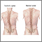 Scoliosis Scoliosis