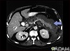 Pancreatitis, acute - CT scan Pancreatitis, acute - CT scan