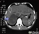 Adrenal Tumor - CT Adrenal Tumor - CT