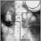 Ileus - X-ray of distended bowel and stomach Ileus - X-ray of distended bowel and stomach