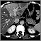Liver with disproportional fattening - CT scan Liver with disproportional fattening - CT scan