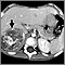 Neuroblastoma in the liver - CT scan Neuroblastoma in the liver - CT scan
