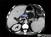 Pancreatic pseudocyst - CT scan Pancreatic pseudocyst - CT scan