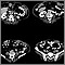 Peritoneal and ovarian cancer, CT scan Peritoneal and ovarian cancer, CT scan