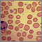 Red blood cells - spherocytosis Red blood cells - spherocytosis