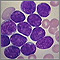 Acute lymphocytic leukemia - photomicrograph Acute lymphocytic leukemia - photomicrograph