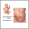 Intestinal obstruction (pediatric) - series