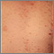Chickenpox - lesions on the chest Chickenpox - lesions on the chest