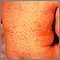 Rubella on an infant's back Rubella on an infant's back