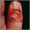 Herpetic whitlow on the thumb Herpetic whitlow on the thumb
