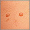 Molluscum contagiosum - close-up Molluscum contagiosum - close-up