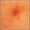 Molluscum contagiosum - close-up of the chest Molluscum contagiosum - close-up of the chest
