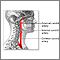 Carotid artery surgery - series Carotid artery surgery - series