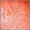 Dermatitis, herpetiformis - close-up of lesion Dermatitis, herpetiformis - close-up of lesion