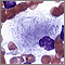 Gaucher cell - photomicrograph Gaucher cell - photomicrograph
