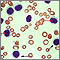 Hairy cell leukemia - microscopic view Hairy cell leukemia - microscopic view