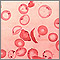 Red blood cells - sickle and Pappenheimer Red blood cells - sickle and Pappenheimer