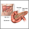 Pancreatitis - series Pancreatitis - series