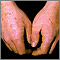 Erythema multiforme on the hands Erythema multiforme on the hands
