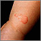 Ringworm - tinea corporis on an infant's leg Ringworm - tinea corporis on an infant's leg